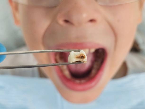 Best Emergency Dental Extractions in Ronan, MT